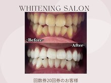 ホワイト つくば店(WHITE)/【30トーンup】プラチナコース