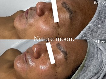 ナチュールムーン(Nature moon.)/ハーブピーリング