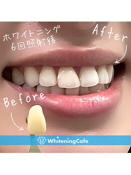 ホワイトニングカフェ 三島店/★Before→ After