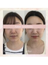 アメル エスティック(Amel esthetic)/小顔矯正