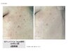 ニキビケア・シミケア・毛穴ケアに♪　光フェイシャル　￥3,300