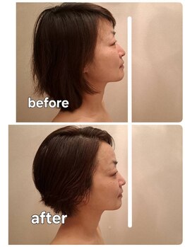 アカラ(Akala)/小顔矯正 週1、4回施術