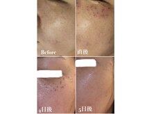 ヴィアージュ(Viage)/シミケア