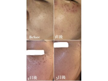 ヴィアージュ(Viage)/シミケア