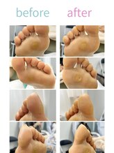 巻き爪補正店 富山店/タコ・魚の目