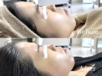 ヴィーナスプロ 岡山駅前(Venus Pro)/【顔脱毛】Before After＊