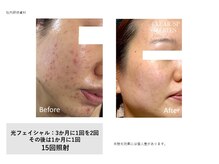 フェレザ 新潟(Felleza)/光フェイシャル女性スタッフ施術
