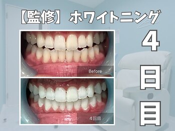 エックス(X)/【監修】ホワイトニング