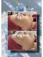 プリマプリート 各務原店/ピーリング&ハリケア最強コラボ