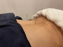 長者町ビオス整骨院/鍼施術