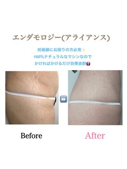 アイリス(AIRIS)/痩身/リンパケア/マッサージ