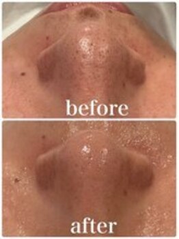 ベルフィーヌ 目黒店(BELFINE)/SNSで話題!つるん毛穴洗浄