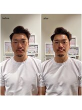 アネラ(ANERA)/小顔矯正&毛穴洗浄BeforeAfter