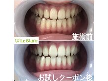 ルブラン 奈良店(Le Blanc)/スピーディに白くしたい方は
