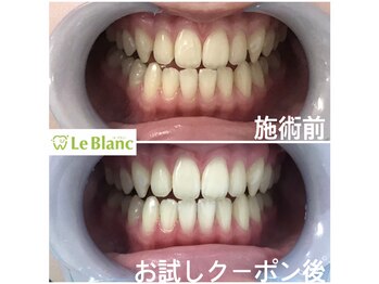 ルブラン 奈良店(Le Blanc)/スピーディに白くしたい方は