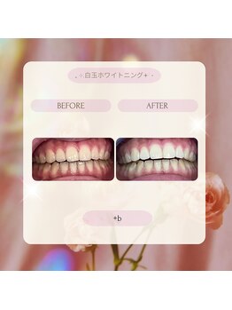 プラスビーセルフ(+b self)/ホワイトニングビフォーアフター