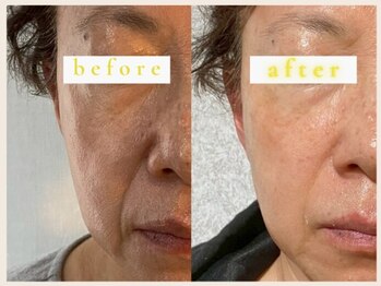 アンベリール(embellir)/タイムロック　1回☆ビフォアフ