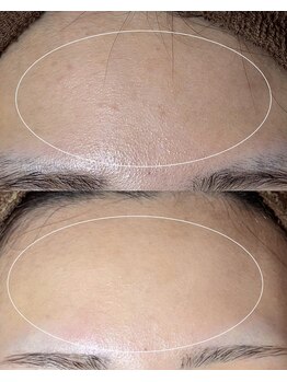 ソワ 吉塚店(soi)/ざらついていたお肌も?!