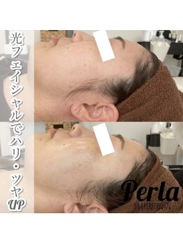ぺルラ 島田駅前店(Perla)/光フェイシャル