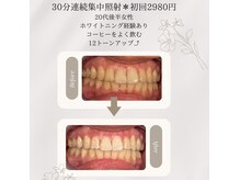 プラスビーセルフ(+b self)/ホワイトニングビフォーアフター