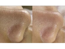 パナケイア(PANAKCEA)の雰囲気（結果重視！長年気になってた毛穴も1度で効果を実感毛穴スッキリ）