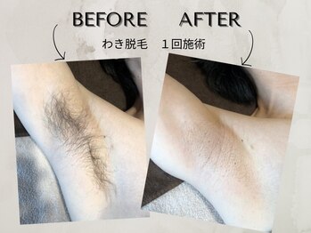 ワンアップ(One-up)/わき脱毛 １回　before　after