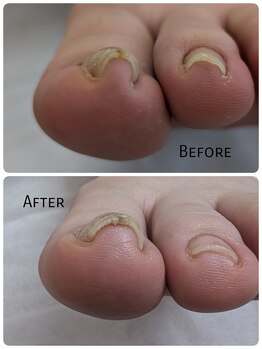 リゼラアンドコー 旭川店/巻き爪　before　after