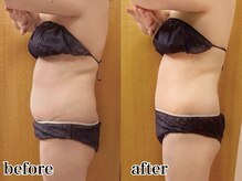 リーインカーナ アーティスト(REINCARNA ARTIST)/【ボディ痩身】ビフォーアフター