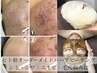【ニキビ・毛穴特化◎】ハーブピーリング【剥離なし】天然×ヒト幹細胞配合