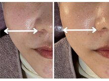 エルナ(ELUNA)/3か月肌改善プログラム　40代