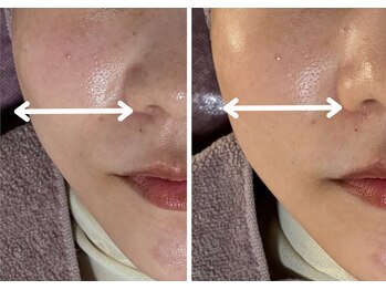 エルナ(ELUNA)/3か月肌改善プログラム 40代