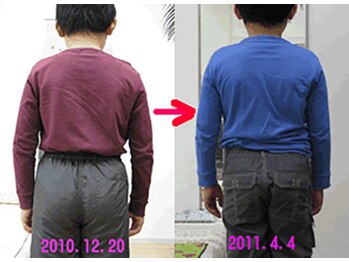 エスコート芦屋サロン/10代 男児 側湾・初期 9.7度