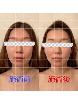 グロッシー(glossy)/小顔矯正