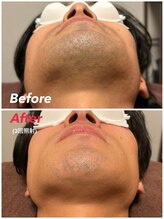 スーパースカルプ 大津店(SuperScalp)/ヒゲ脱毛３回時点before/after