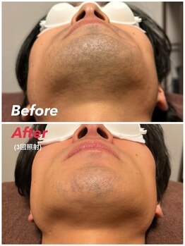 スーパースカルプ 大津店(SuperScalp)/ヒゲ脱毛3回時点before/after