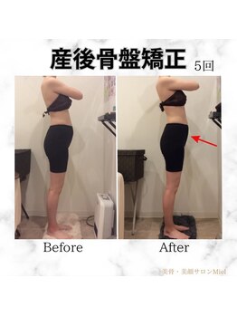 ミエル(Miel)/Before After