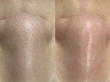 ヴィーヴ 京橋(vive)/【韓国式3D毛穴洗浄】