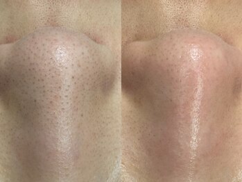 ヴィーヴ 京橋(vive)/【韓国式3D毛穴洗浄】