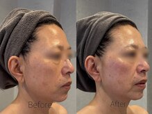 サロンベイア(salon Beia)/幹細胞エステ1回の変化