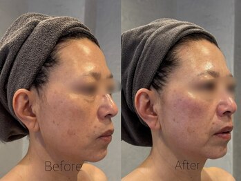 サロンベイア(salon Beia)/幹細胞エステ1回の変化