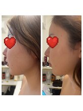 美温(mion)/術前インディバ