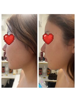 美温(mion)/術前インディバ