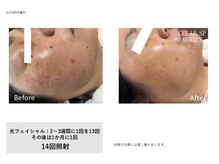 フェレザ 新潟(Felleza)/光フェイシャル女性スタッフ施術