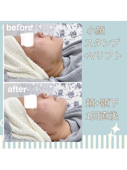 ハロ 南青山(HALO)/小顔スタンプ+Vリフト5,000s