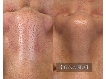 ル シーニュ/プロセルフェイシャル×10回