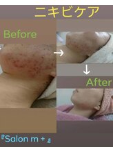 サロンエム(Salon m)/ニキビケア、アフターケア