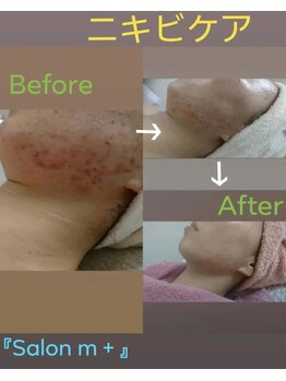 サロンエム(Salon m)/ニキビケア、アフターケア