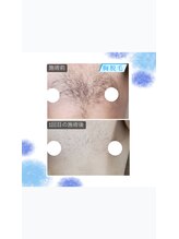 プレジール(PLAISIR)/30代男性　胸脱毛