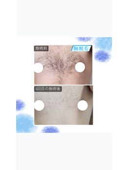 プレジール(PLAISIR)/30代男性 胸脱毛