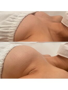 メゾン アンジュ(Maison Ange)/バストアップ症例/バスト/育乳